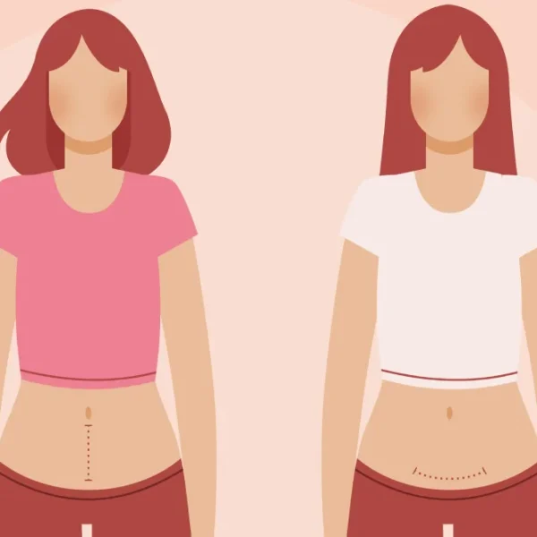 لاغری زیر شکم