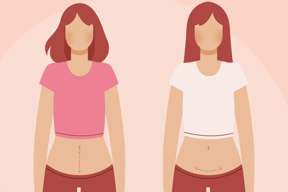 لاغری زیر شکم